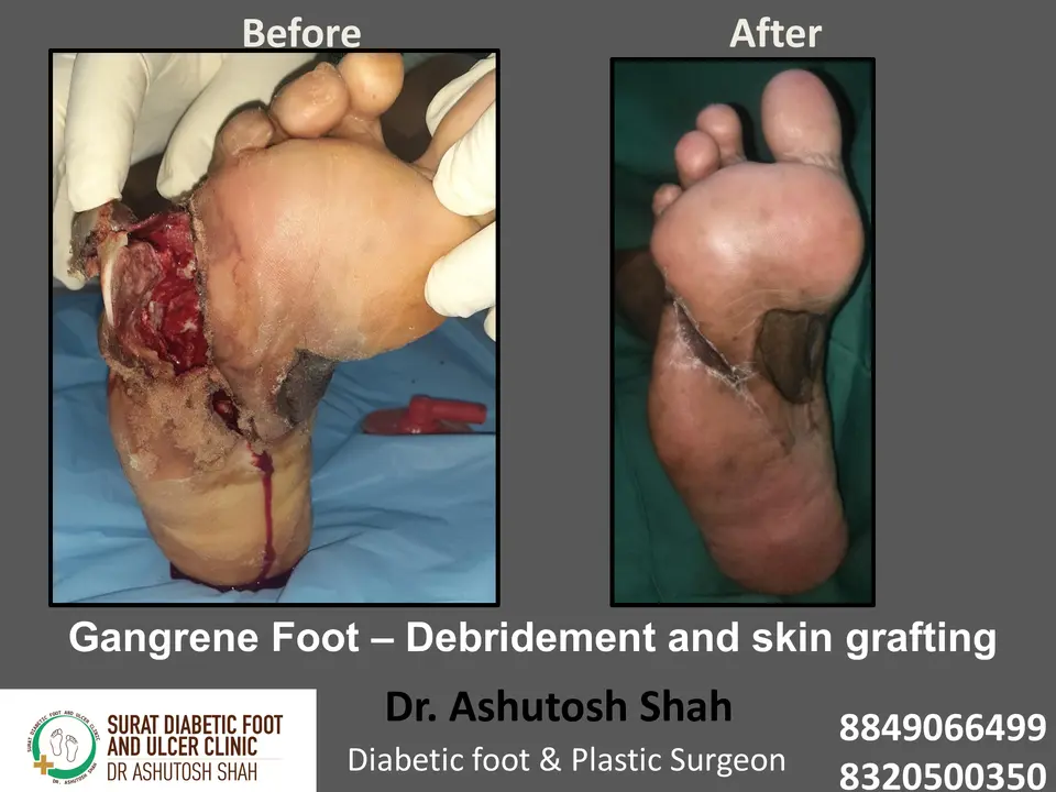 Diabetic Foot  PPT 3 checked by sir.pptx-18.webp